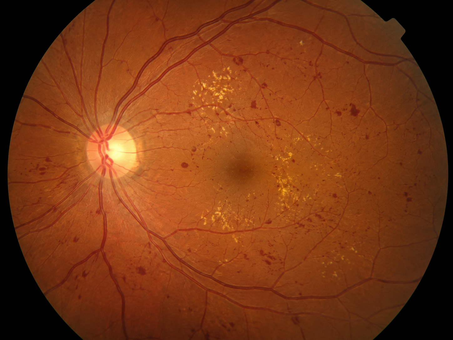 Ocular Disease